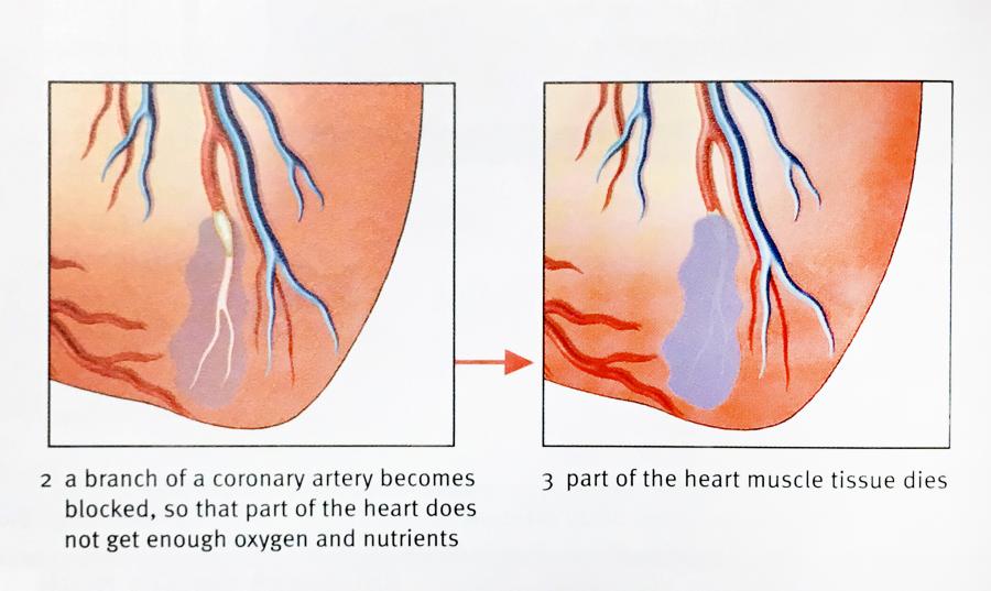写真・図版 : 「Your biology」に掲載された心筋梗塞の解説