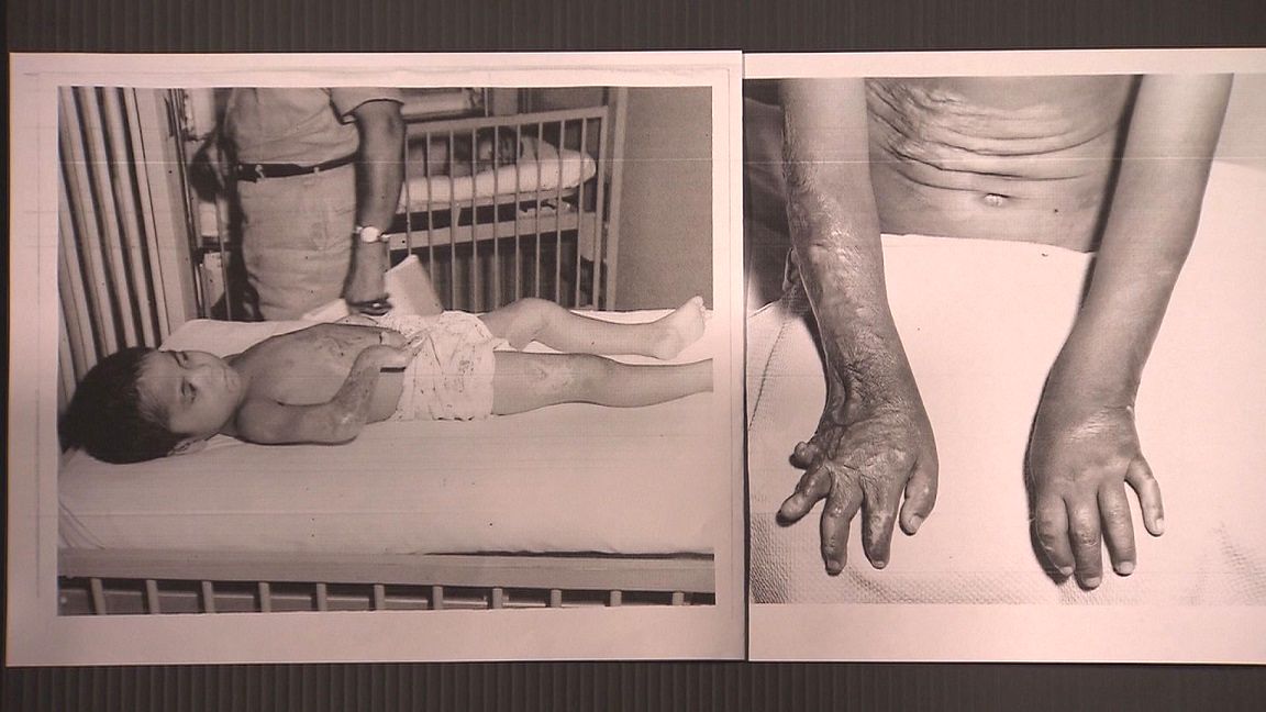写真・図版 : 米陸軍病院に入院中の玉城さん（1961年の医療報告書より）