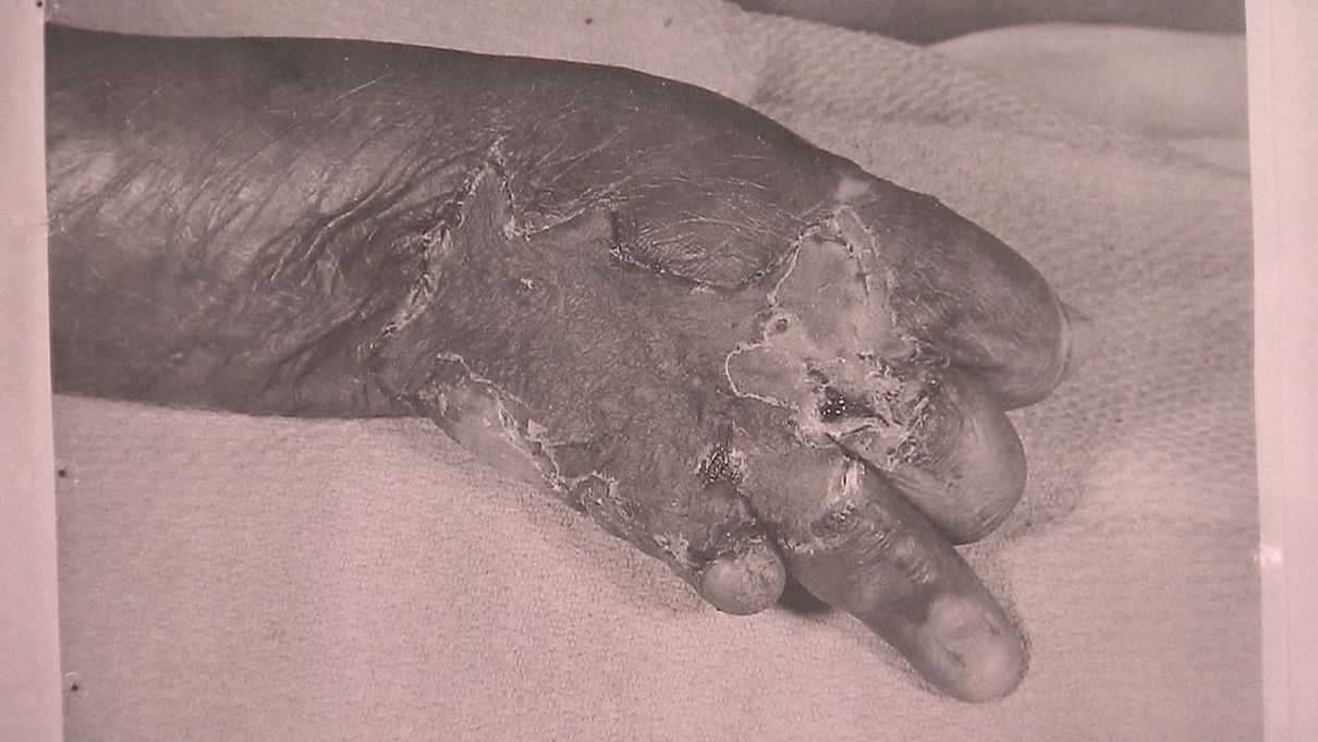 写真・図版 : 大やけどをした玉城さんの右手（1961年の医療報告書より）