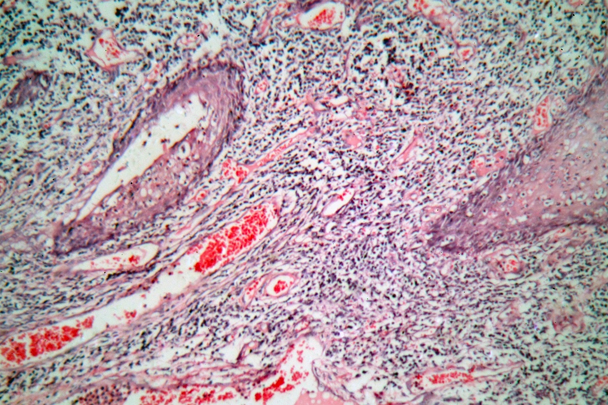 写真・図版 : 子宮頸がん細胞を含むヒト子宮頸部の組織細胞の顕微鏡写真　shutterstock.com
