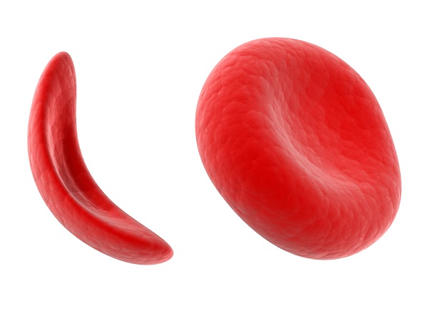 写真・図版 : 正常な赤血球（右）と鎌状赤血球（左）＝shutterstock.com 