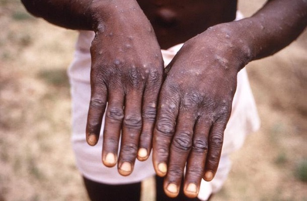1997年にアフリカで確認されたサル痘患者の手の様子=米疾病対策センター(CDC)提供