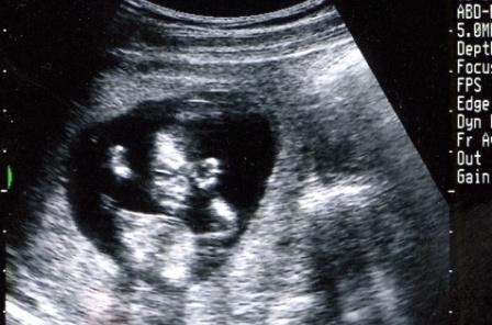 写真・図版：新たな出生前診断の問題点